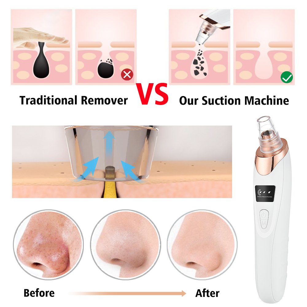 البثرة مزيل فراغ المسام نظافة  - مراجعة Nasal Aspirator وسعره